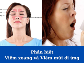 Phân biệt viêm mũi dị ứng và viêm xoang